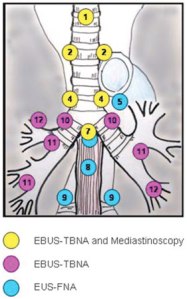 From: http://69.36.35.38/accp/pccsu/minimally-invasive-techniques-diagnosing-and-staging-lung-cancer?page=0,3