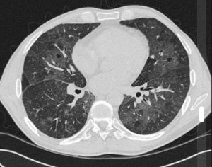 RB-ILD from Radiopaedia.org