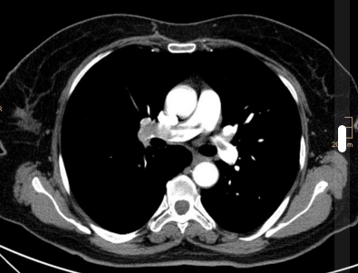 Pulmonary embolism. Case courtesy of Dr Stefan Ludwig, Radiopaedia.org. From the case rID: 13894
