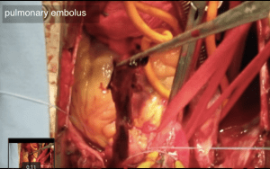 Surgical pulmonary thrombectomy via YouTube: https://www.youtube.com/watch?v=9_tXeehmbD4